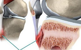 Người trẻ chớ chủ quan: BS khuyến cáo đây là loại ung thư thường gặp ở trẻ 9 – 19 tuổi