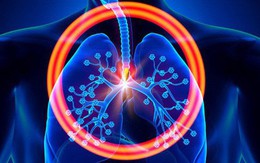 Hơn 20.000 người Việt tử vong do ung thư phổi mỗi năm: Phát hiện bệnh sớm để sống lâu hơn