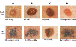 Khi nào nốt ruồi có nguy cơ thành ung thư: Ghi nhớ dấu hiệu ABCDE ngay lập tức