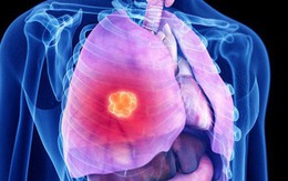 4 việc quan trọng phải làm để ngăn ung thư phổi: Tiếc rằng nhiều người biết quá muộn