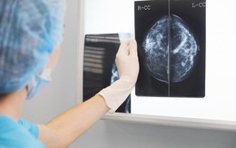 Mỹ: Tỷ lệ tử vong do ung thư vú giảm đến hơn 50% vào năm 2018, chúng ta học được điều gì từ đây?