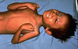 Trung tâm kiểm soát và phòng ngừa dịch bệnh Mỹ lên tiếng: Một cậu bé 6 tuổi suýt chết vì uốn ván do bố mẹ anti-vaccine