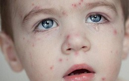 Miễn dịch cộng đồng: Điều gì sẽ xảy ra với con bạn, nếu đứa trẻ hàng xóm không được tiêm phòng?