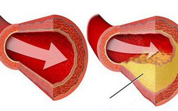 Bệnh mỡ máu cao "không trừ một ai": Muốn không có bệnh thì nên chú ý 7 điều quan trọng