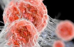 PCT Hội Ung thư chỉ cách phát hiện 3 loại ung thư hay mắc nhất trước khi có dấu hiệu bệnh