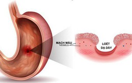 7 triệu chứng không đau có thể là dấu hiệu sớm của ung thư: Khám sớm có thể cứu sống bạn