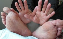 Cha mẹ cảnh giác với 3 dấu hiệu cảnh báo trẻ bị tay chân miệng thể nặng, ảnh hưởng đến thần kinh