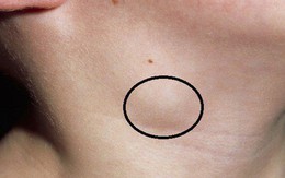 Cần cảnh giác với cục cứng nổi ở cổ: Cách nhận biết dấu hiệu ung thư tuyến giáp