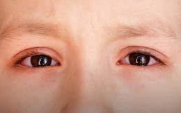Đau mắt đỏ có thể bùng phát trong mùa hè, muốn phòng bệnh hãy làm đủ 5 việc này mỗi ngày