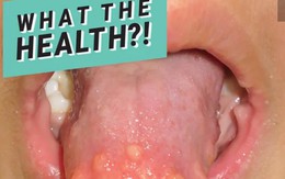 Nếu lưỡi của con bạn có dấu hiệu tương tự như em bé này, cẩn thận với bệnh ung thư tuyến giáp!