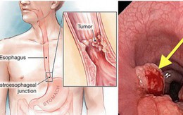 Bị ung thư lại tưởng viêm họng: 3 dấu hiệu điển hình cần nhớ, ai có cần đi khám sớm