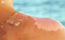 Chuyên gia da liễu hướng dẫn cách chống nắng hoàn hảo khi đi biển, ngăn chặn cháy nắng, bỏng nắng và cả ung thư da