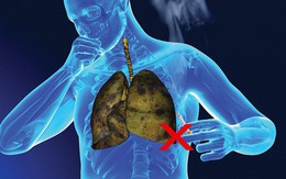 Cảnh báo: Người hút đến 2 bao thuốc mỗi ngày, hoặc liên tục tiếp xúc với khói thuốc phải xét nghiệm ung thư phổi ngay trước khi quá muộn