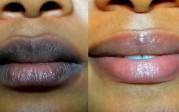 Màu môi thay đổi là dấu hiệu cảnh báo bệnh phổi nguy hiểm: Tấn công cả người trẻ tuổi