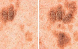 5 biểu hiện lạ của nốt ruồi mà bạn cần hết sức chú ý, có thể có nguy cơ bị ung thư da