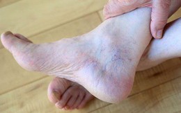 4 triệu chứng dễ thấy ở bàn chân, cảnh báo gan của bạn đang hoạt động kém