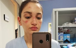 Thảm cảnh với y bác sĩ Vũ Hán tái diễn ở Italy: Nhân viên y tế tím mặt vì đeo khẩu trang, ngủ gục trên bàn vì kiệt sức