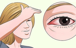 Vì sao mắt cứ bị đỏ ngầu sau khi tỉnh dậy? Đó cũng là cảnh báo sức khoẻ bạn cần chú ý