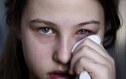 Viện Hàn lâm Nhãn khoa Hoa Kỳ: Đau mắt đỏ nhẹ có thể là triệu chứng của một người mắc COVID-19