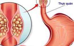 Phát hiện ung thư nhờ miếng thịt ngan: Bác sĩ nhắc khi ăn có dấu hiệu này phải khám ngay