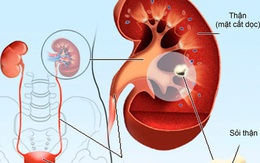 Bác sĩ khoa Thận nhắc bạn 6 điều quan trọng giúp thận khoẻ, tránh được các bệnh về thận