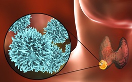 Ung thư tuyến giáp ngày càng trẻ hoá: Thấy 6 điểm bất thường này xung quanh vùng cổ thì bạn nên đi khám ngay