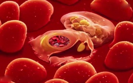Loại virus duy nhất được cho là có thể gây bệnh ung thư máu nguy hiểm như thế nào?