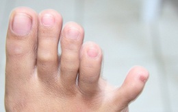 Thận có khỏe hay không, cứ nhìn vào 4 đặc điểm ở bàn chân là rõ ngay vấn đề