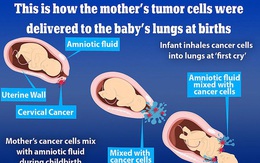 Sốc: 2 trẻ sơ sinh Nhật Bản hít phải tế bào ung thư từ mẹ