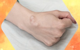 BS khuyến cáo về các loại u vùng cổ tay hay gặp: Đừng bỏ qua vì đó có thể là dấu hiệu cảnh báo bệnh nguy hiểm