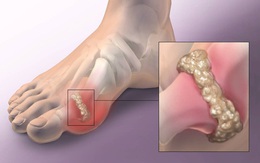 Trời lạnh bệnh gút dễ "nổi loạn": 3 thói quen nên bỏ ngay và 2 cách đơn giản để chống lại