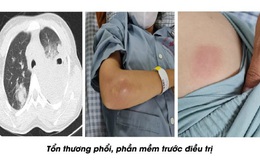 Nữ bệnh nhân mắc bệnh Whitmore ở Phú Thọ được cứu sống kịp thời