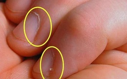 3 biểu hiện trên móng tay đang cảnh báo bạn bị thiếu máu, không phát hiện ra sớm để bồi bổ thì cơ thể sẽ sinh bệnh
