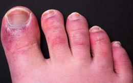 Triệu chứng Covid-19 đáng sợ ở chân: Chuyên gia 'vạch mặt' thủ phạm gây ra ‘ngón chân Covid’
