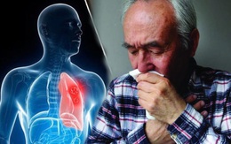 Người đàn ông 47 tuổi được chẩn đoán bị ung thư phổi: Bác sĩ cảnh báo nếu cơ thể xuất hiện "1 dày, 2 đen, 3 đau" này thì phải đi khám ngay kẻo phổi nát, cái chết gần kề