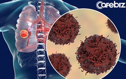 Có 3 điểm bất thường ở TAY và BẢ VAI cảnh báo sớm ung thư phổi, đi chụp chiếu ngay mới mong tăng tỉ lệ sống!