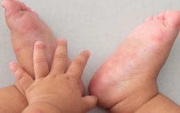 Bé 19 tháng tuổi tử vong nghi do tay chân miệng: Những biến chứng nghiêm trọng, cách nhận biết, điều trị bệnh cha mẹ cần nắm được