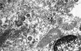 Bác sĩ công bố hình ảnh "phiên bản đời thực" của virus SARS-CoV-2 chụp từ tế bào bệnh nhân