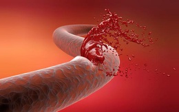 Mạch máu có thể "đầy rác" ở tuổi 20: Cảnh giác với 5 dấu hiệu tắc nghẽn mạch máu này, nếu thấy cần xử lý ngay