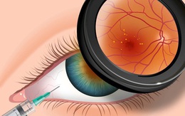 3 biểu hiện bất thường ở đôi mắt ngầm cảnh báo nguy cơ mắc bệnh tiểu đường rất cao mà bạn cần chú ý