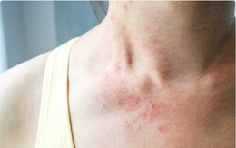 3 biểu hiện bất thường trên da tuyệt đối không được bỏ qua: Đốm và nốt ruồi tưởng như rất bình thường lại có thể là mầm mống của u ác tính
