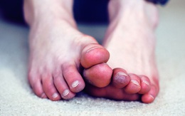5 triệu chứng ở chân cho thấy cơ thể bạn đang trên đà lão hóa, mắc phải dù chỉ 1 cái cũng đã rất đáng lo