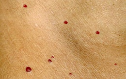 “Nốt ruồi đỏ” nhiều khi chẳng phải phúc mà là hoạ, nếu thấy cơ thể xuất hiện loại nốt ruồi đỏ này cần đi khám ngay