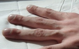 4 triệu chứng trên ngón tay cho thấy chất độc trong cơ thể gần như bùng phát, hãy nhanh chóng đi tầm soát ung thư gan, phổi trước khi quá muộn