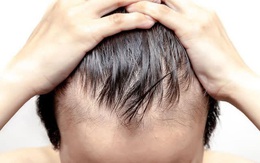 Cẩn thận nếu đầu tóc bạn xuất hiện 6 dấu hiệu này: Bết, thưa, rụng hay bạc sớm không đáng sợ bằng điều này