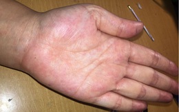 Người có gan kém thường có 4 biểu hiện bất thường ở bàn tay, nếu không có thì gan vẫn rất khỏe mạnh