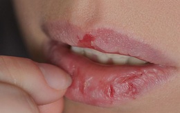 4 dấu hiệu bất thường ở miệng cảnh báo gan đang có vấn đề, cần điều trị càng sớm càng tốt