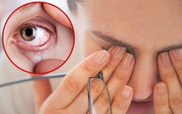 3 biểu hiện bất thường ở mắt ngầm cảnh báo gan có vấn đề, xem thử bạn có dấu hiệu nào hay không