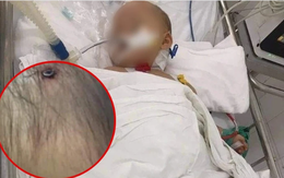 Xuất hiện hình ảnh nghi là bé gái 3 tuổi ở Hà Nội với chiếc đinh lớn cắm thẳng vào đầu khiến dân mạng dậy sóng