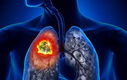 Bệnh nhân ung thư phổi giai đoạn cuối vẫn sống tiếp 10 năm: Bác sĩ khẳng định yếu tố quan trọng giúp đạt hiệu quả trong điều trị không chỉ có thuốc